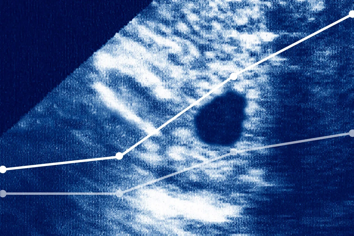 A Disturbing Surge: Ectopic Pregnancy Deaths Spike Amidst Abortion Bans and Healthcare Gaps